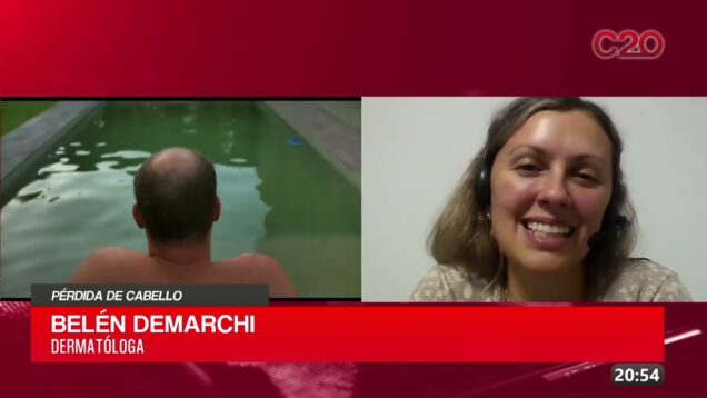 C20 Noticias | Pérdica de cabello – Belén Demarchi